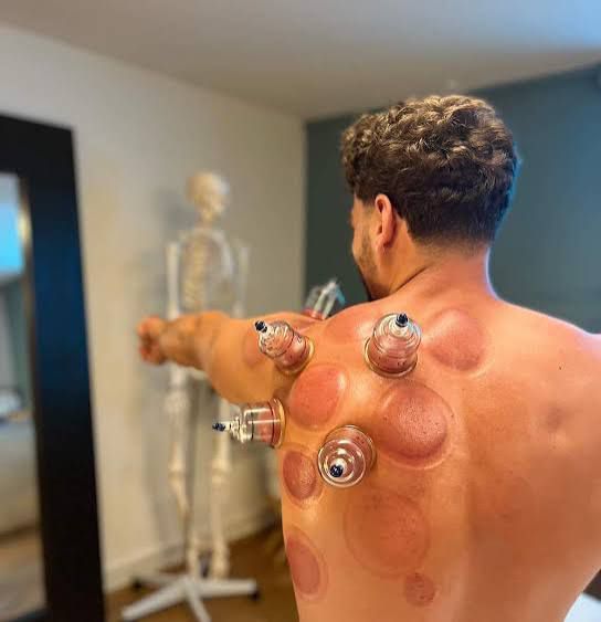Cupping thérapie